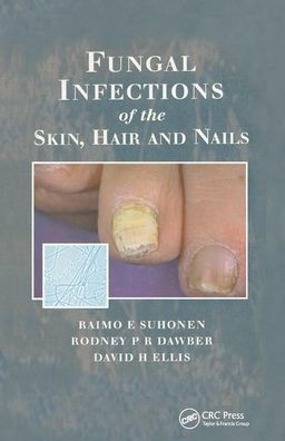 Fungal Infections Of The Skin And Nails