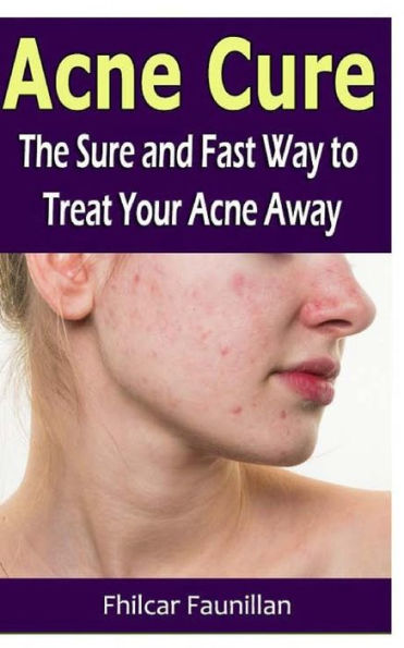 Acne Cure: The Sure And Fast Way To Treat Your Acne Away - 9781530742325