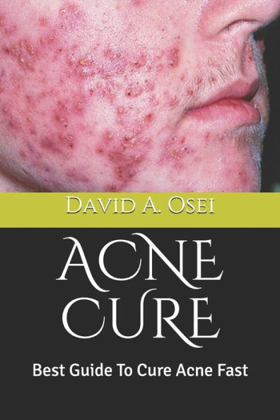 ACNE CURE: Best Guide To Cure Acne Fast