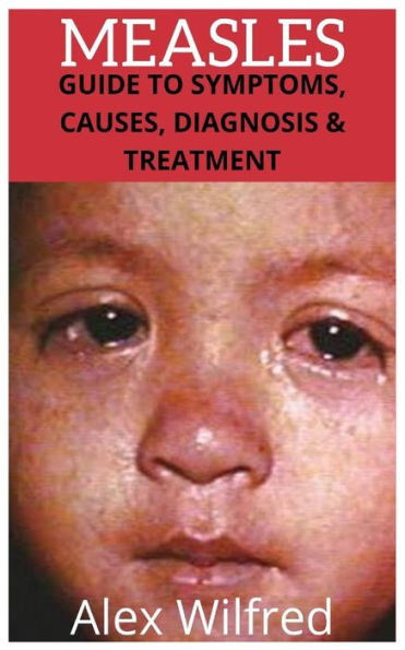 Measles: Guide To Symptoms, Causes, Diagnosis & Treatment