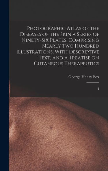 Photographic Atlas Of The Diseases Of The Skin A Series Of Ninety-Six Plates, Comprising Nearly Two Hundred Illustrations, With Descriptive Text, And A Treatise On Cutaneous Therapeutics: 4