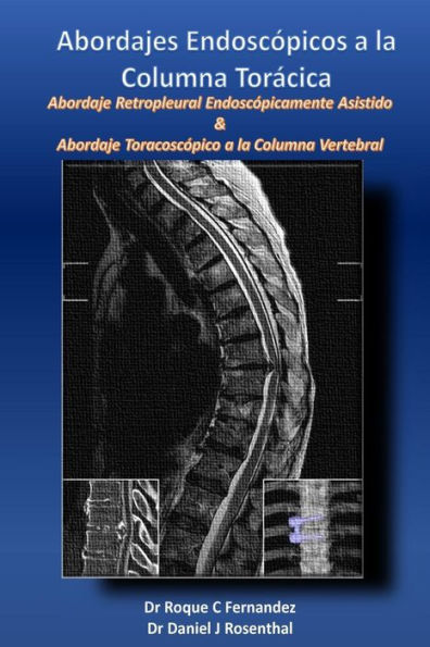 Abordajes Endoscopicos a la Columna Toracica: Abordaje retropleural endoscopicamente asistido & Abordaje toracoscopico a la columna vertebral (Spanish Edition)