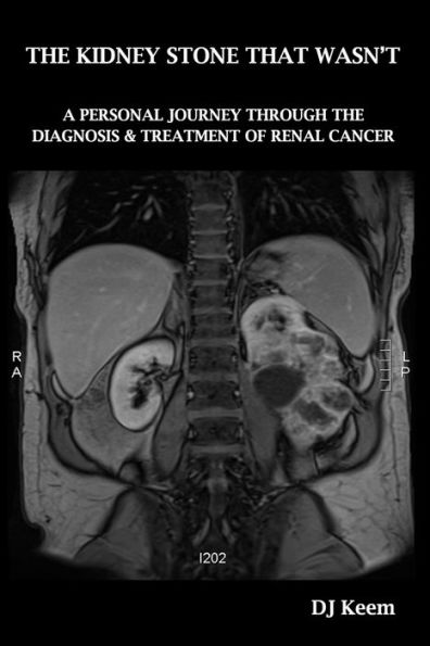 The Kidney Stone That Wasn't : A Personal Journey Through The Diagnosis & Treatment Of Renal Cancer