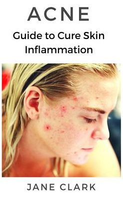 ACNÉ: Guía para curar la inflamación de la piel