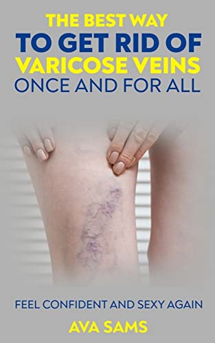 The Best Way to Get Rid of Varicose Veins Once and for All : Feel Confident and Sexy Again