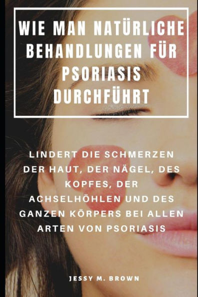 Wie Man Natürliche Behandlungen Für Psoriasis Durchführt : Lindert Die Schmerzen Der Haut, Der Nägel, Des Kopfes, Der Achselhöhlen Und Des Ganzen Körpers Bei Allen Arten Von Psoriasis (German Edition)
